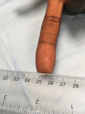 healed finger wound with no scarring