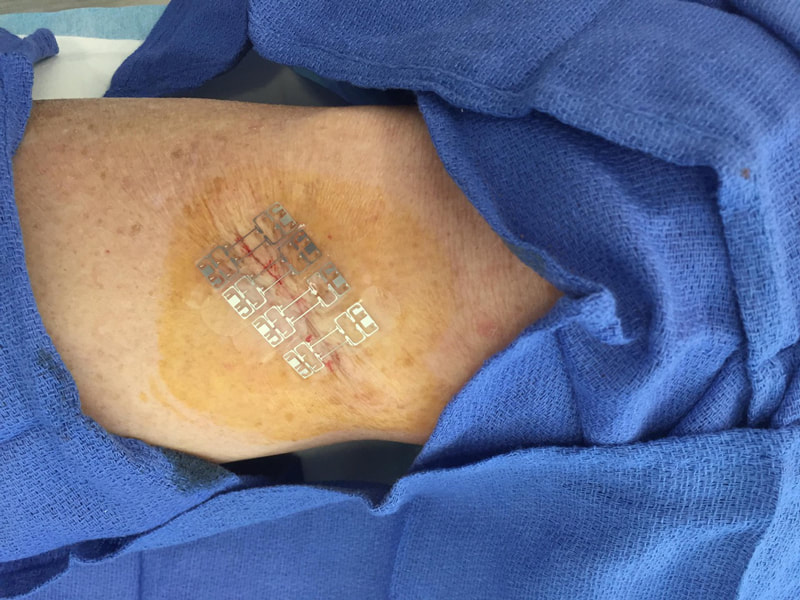 micromend applied to wound on leg