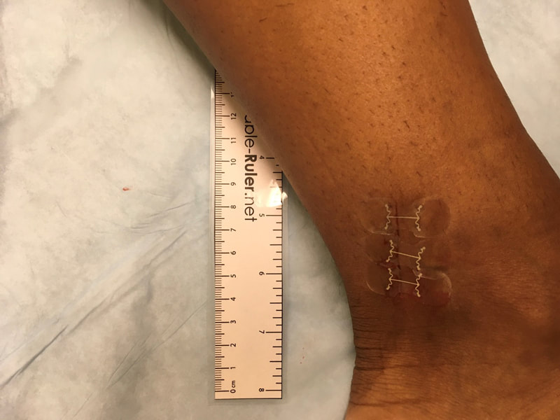 micromend applied to wound on ankle