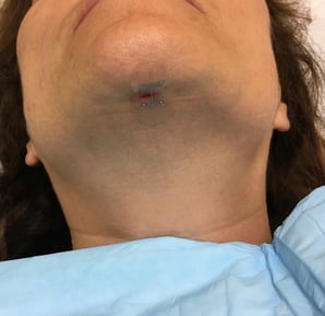 microMend applied under chin