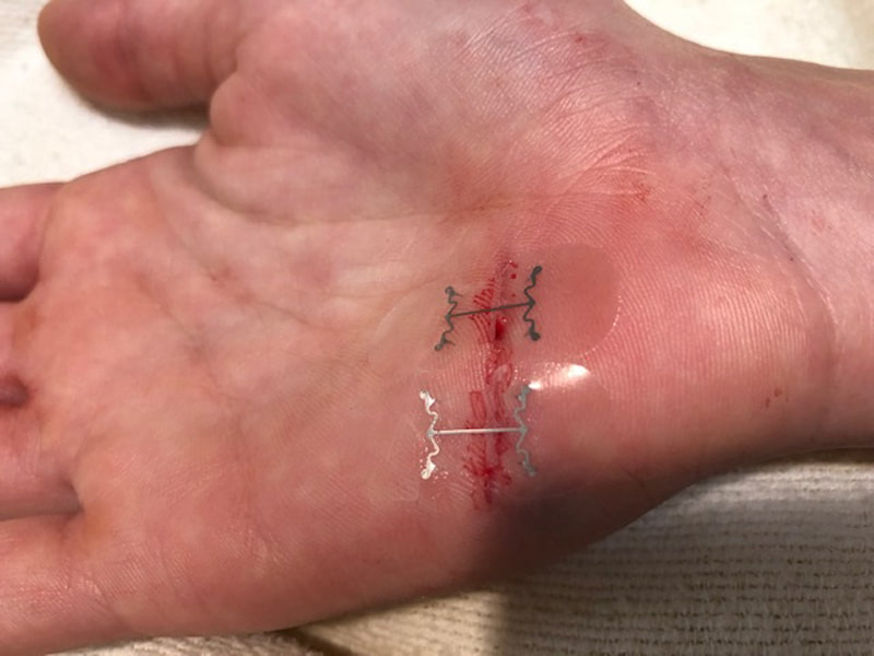 microMend applied to hand
