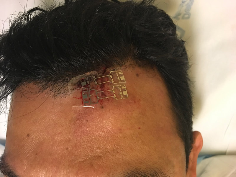 microMend applied to forehead