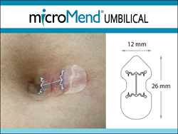 gI_177942_PRWeb microMend UMBILICAL Launch Image