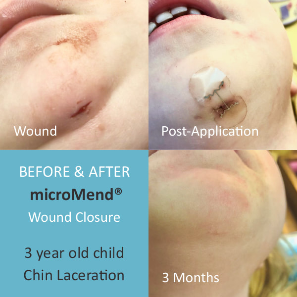Before and After of chin wound