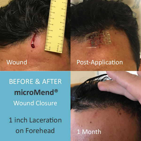 before and after forehead wound