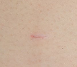 results using micromend for wound closure