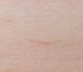 wound closure using micromend 