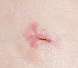 open wound result using sutures not sealed