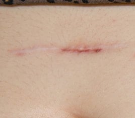 deep scarring result from suture use