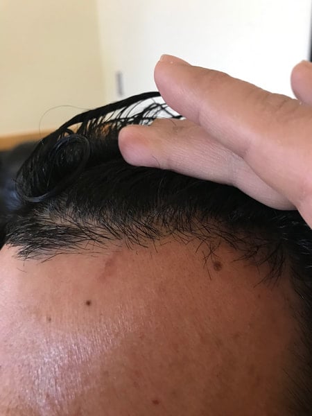 healed forehead from microMend