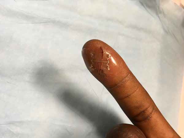 finger wound using micromend