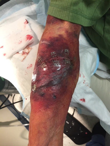 open burn wound using micromend 