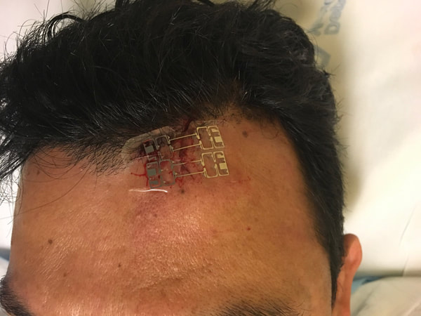 micromend applied on forehead