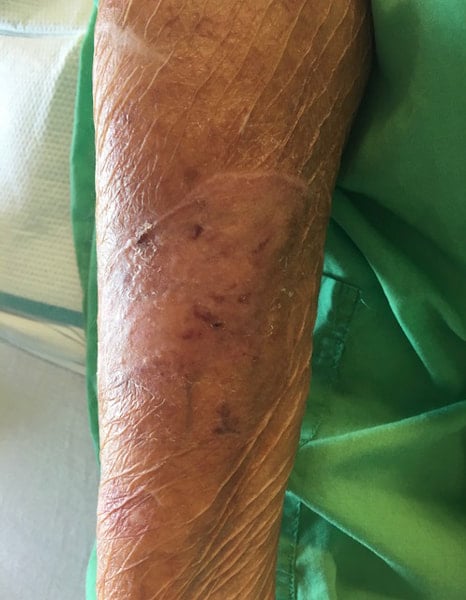 healed burned arm