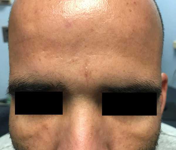 healed wound on forehead