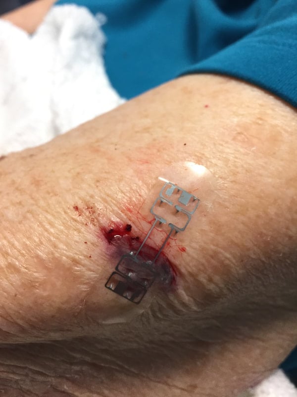 open arm wound with micromend 