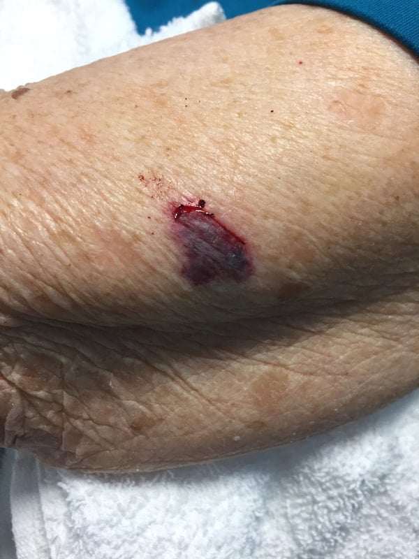 bloody open wound on arm