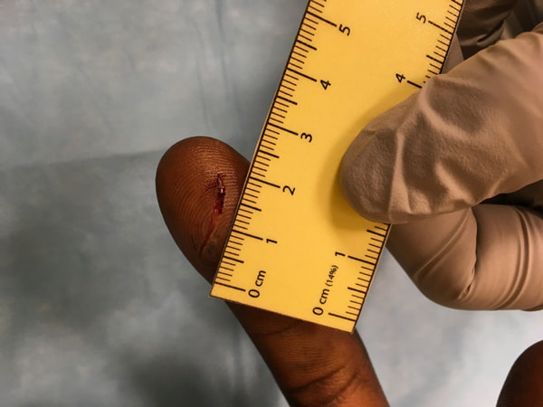centimeter wound on finger