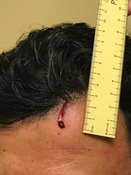 bleeding forehead injury 