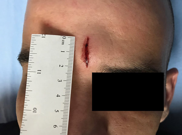 two inch open wound on forehead