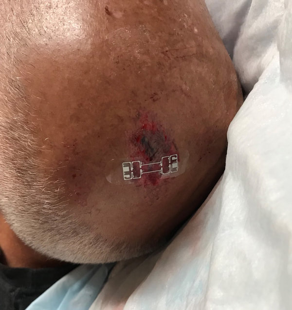 micromend applied to wound on head laceration