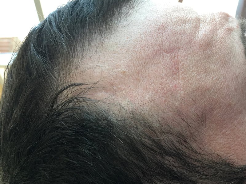 Healed wound on forehead using micromend