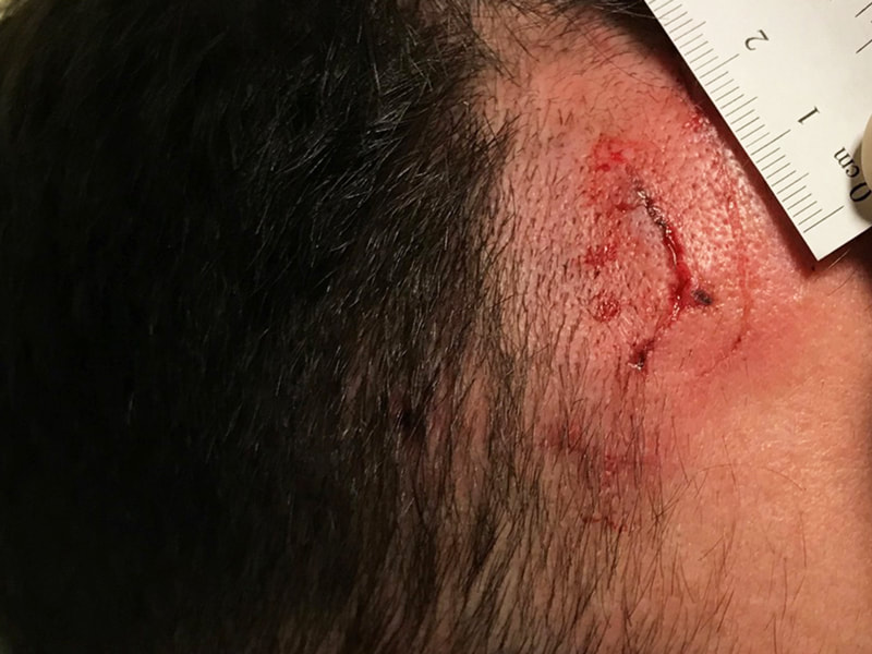 three inch wound on forehead
