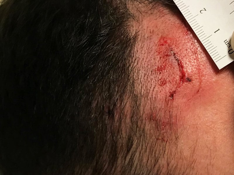 2 in open wound on head