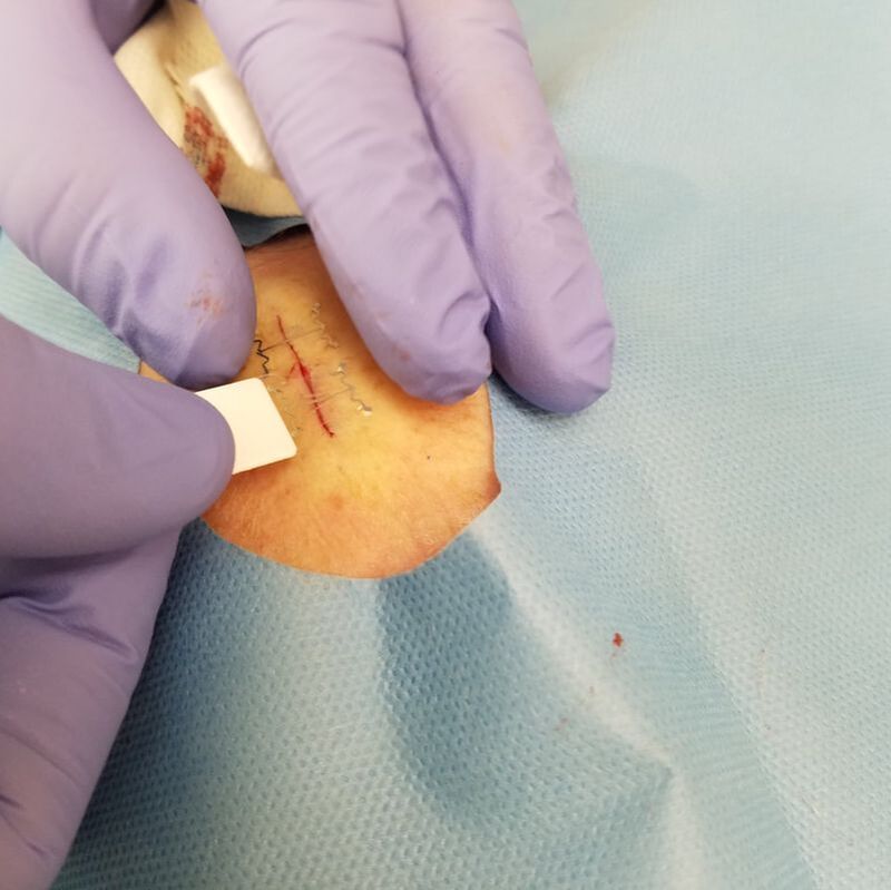 head wound, microMend PRO application process head wound, microMend PRO application process