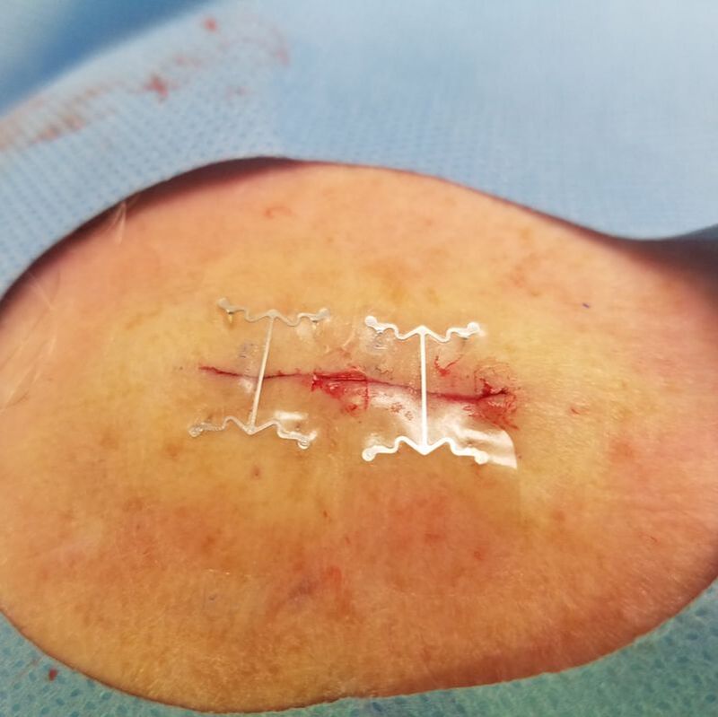 head wound, microMend PRO applied head wound, microMend PRO applied