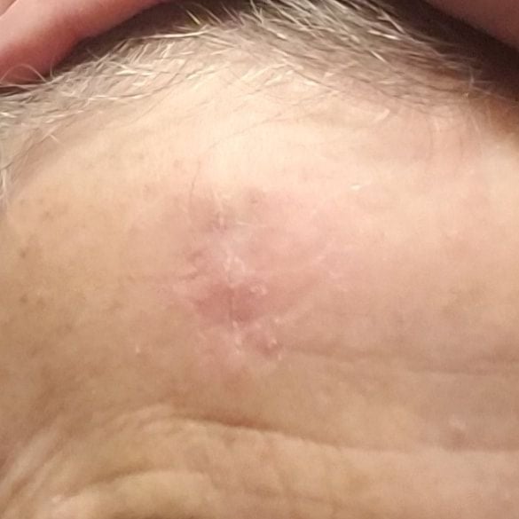 head wound, after 3 months with microMend PRO 