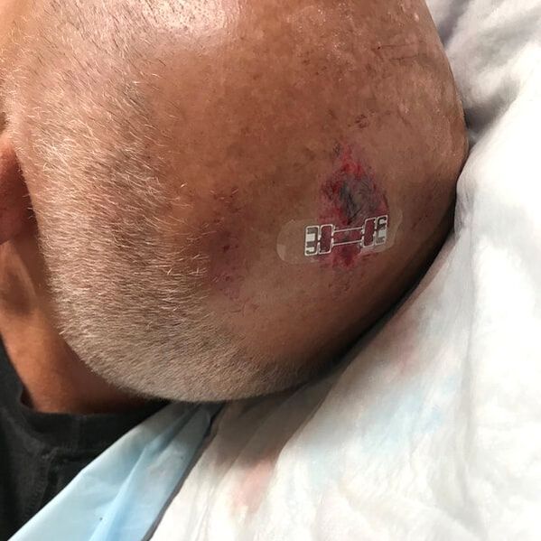 head wound microMend PRO applied head wound microMend PRO applied