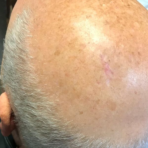 head wound after 3 months of using microMend PRO