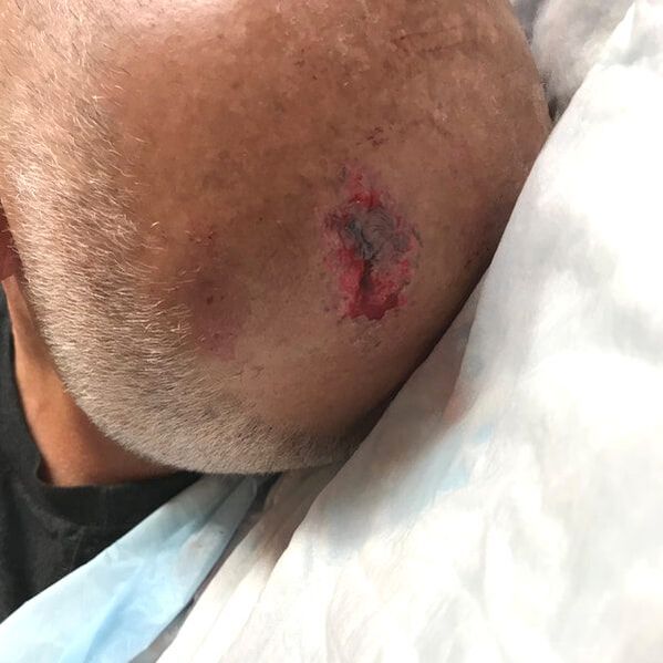 head wound before microMend PRO