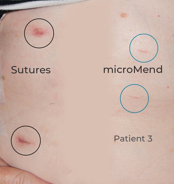 micromend resuults vs suture results in patient 3