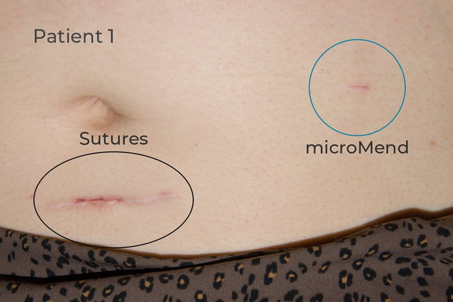 results of sutures vs micromend in patient one