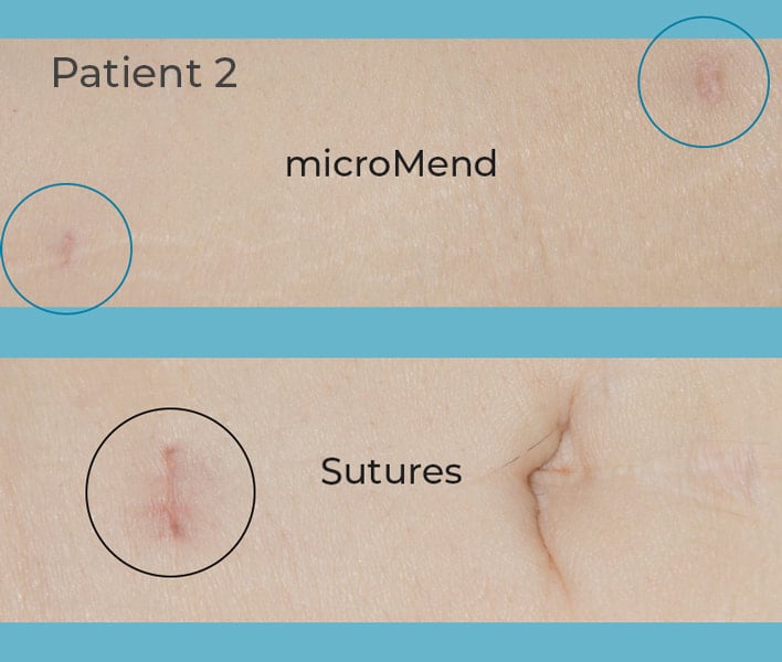 micromend results vs suture results in patient two